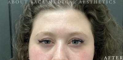 Botox Before & After Gallery - Patient 146210060 - Image 2