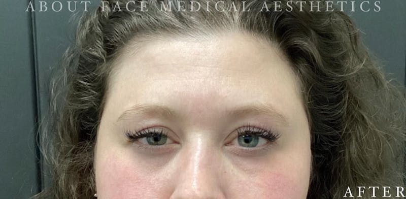 Botox Before & After Gallery - Patient 146210060 - Image 2