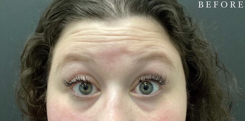 Botox Before & After Gallery - Patient 146210060 - Image 3