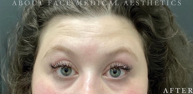 Botox Before & After Gallery - Patient 146210060 - Image 4
