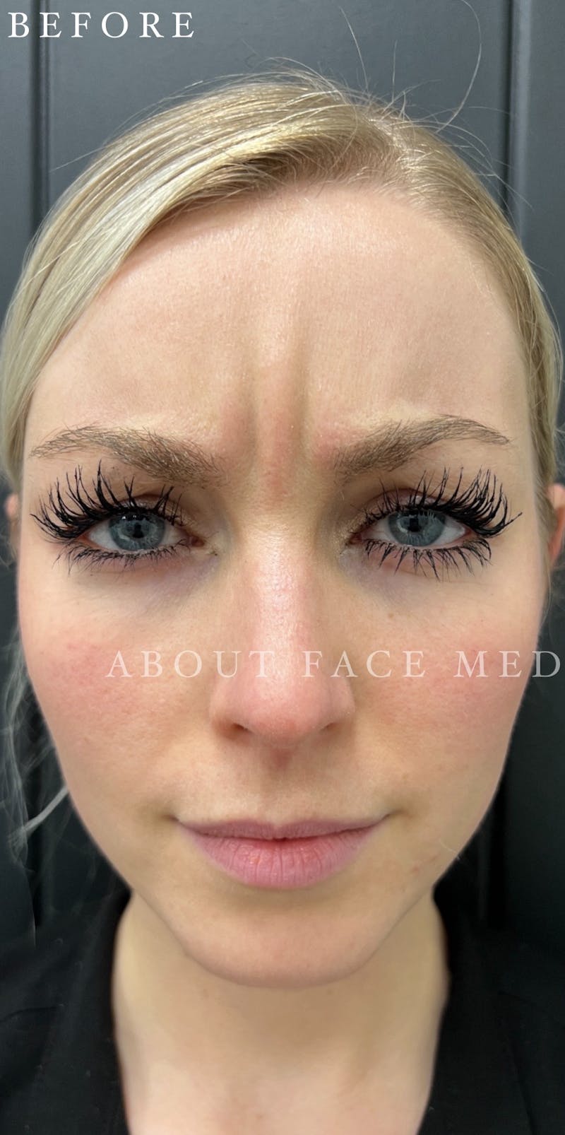 Botox Before & After Gallery - Patient 146210063 - Image 1