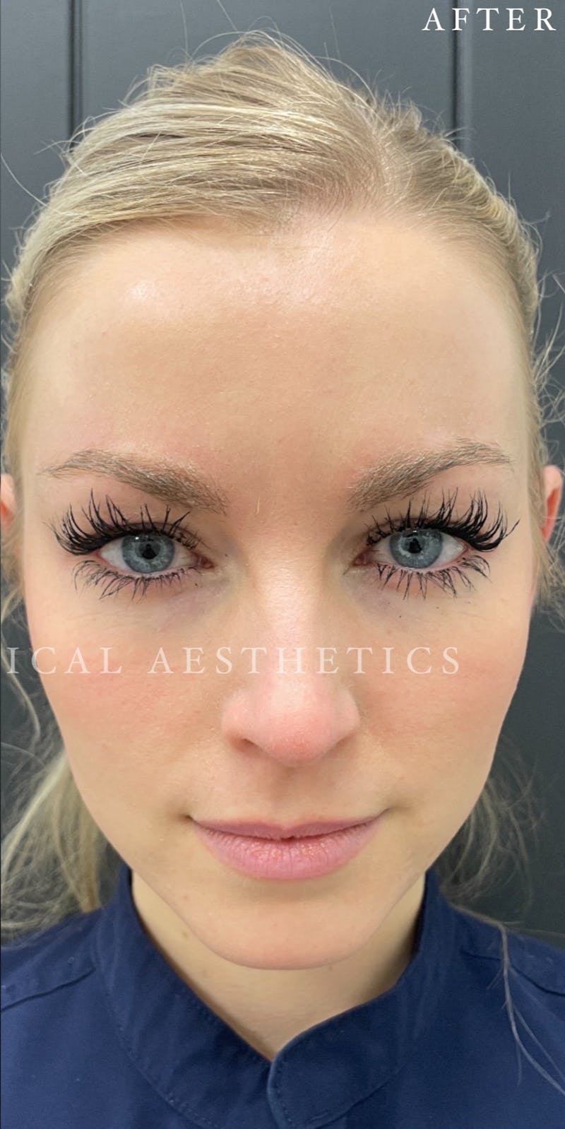 Botox Before & After Gallery - Patient 146210063 - Image 2