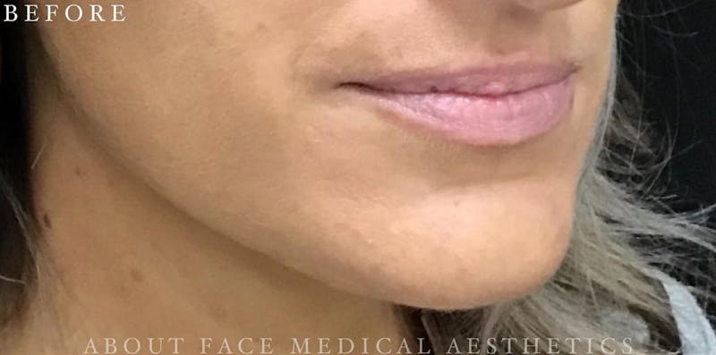 Dermal Filler Before & After Gallery - Patient 146210065 - Image 3