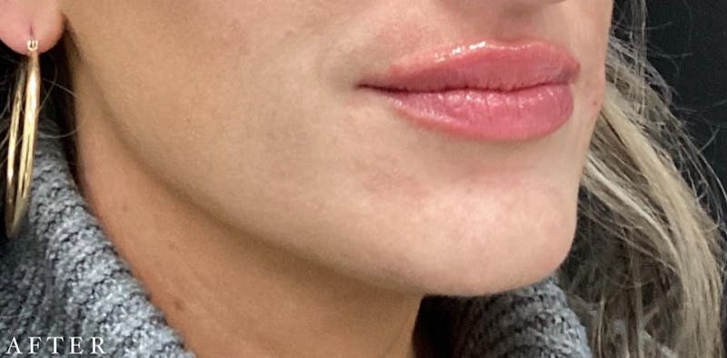 Dermal Filler Before & After Gallery - Patient 146210065 - Image 4