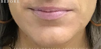 Dermal Filler Before & After Gallery - Patient 146210065 - Image 1