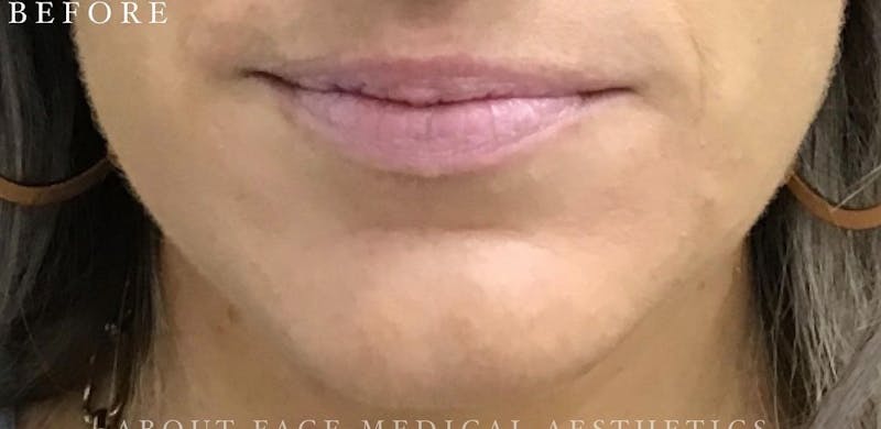 Dermal Filler Before & After Gallery - Patient 146210065 - Image 1