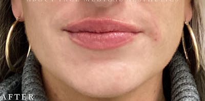 Dermal Filler Before & After Gallery - Patient 146210065 - Image 2