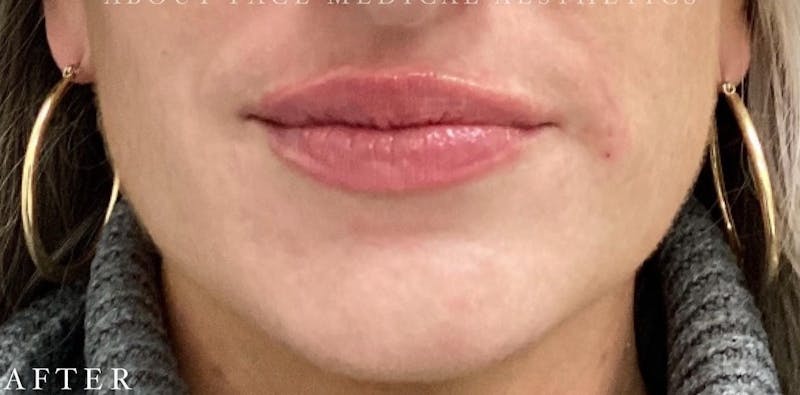 Dermal Filler Before & After Gallery - Patient 146210065 - Image 2