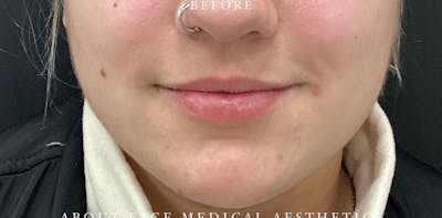Dermal Filler Before & After Gallery - Patient 146210068 - Image 1