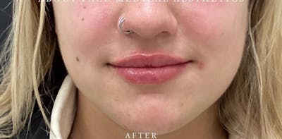 Dermal Filler Before & After Gallery - Patient 146210068 - Image 2