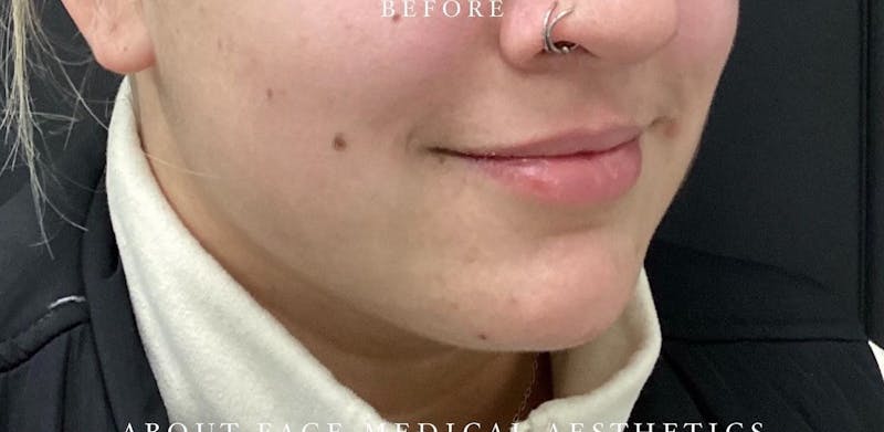 Dermal Filler Before & After Gallery - Patient 146210068 - Image 3