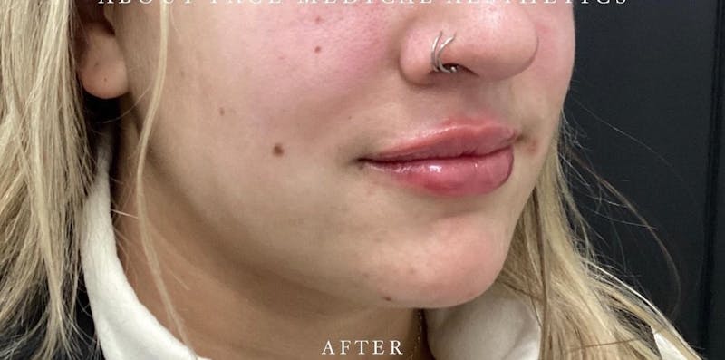 Dermal Filler Before & After Gallery - Patient 146210068 - Image 4