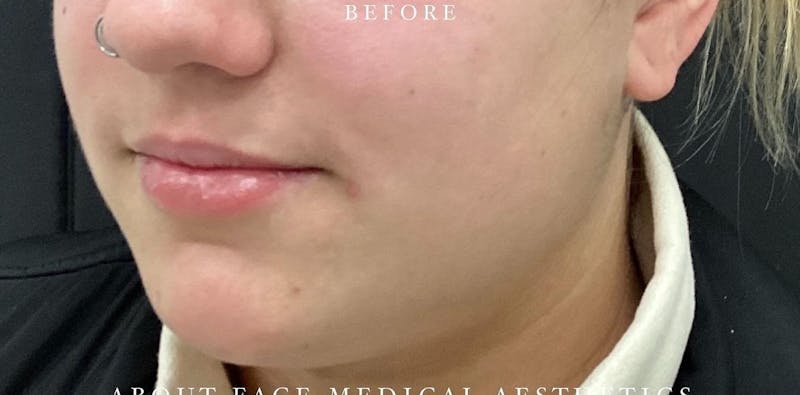 Dermal Filler Before & After Gallery - Patient 146210068 - Image 5