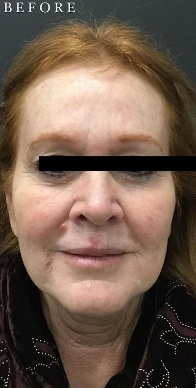 Dermal Filler Before & After Gallery - Patient 146210086 - Image 1