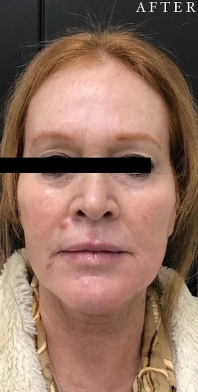 Dermal Filler Before & After Gallery - Patient 146210086 - Image 2