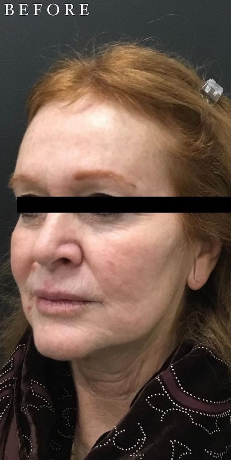 Dermal Filler Before & After Gallery - Patient 146210086 - Image 3