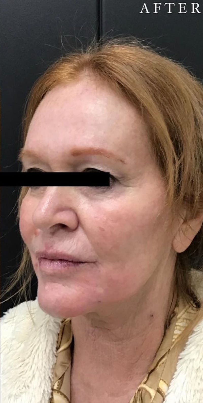 Dermal Filler Before & After Gallery - Patient 146210086 - Image 4