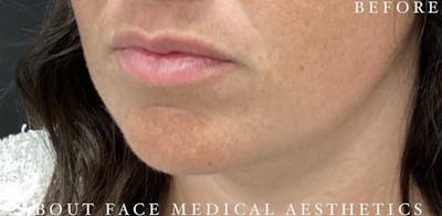 Dermal Filler Before & After Gallery - Patient 146210089 - Image 1