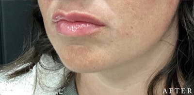 Dermal Filler Before & After Gallery - Patient 146210089 - Image 2