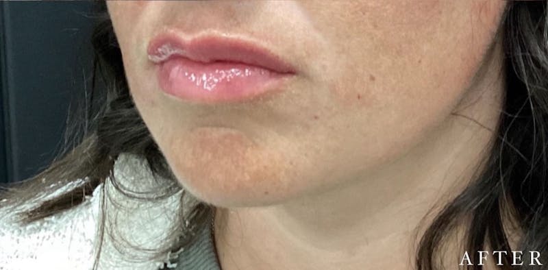 Dermal Filler Before & After Gallery - Patient 146210089 - Image 2