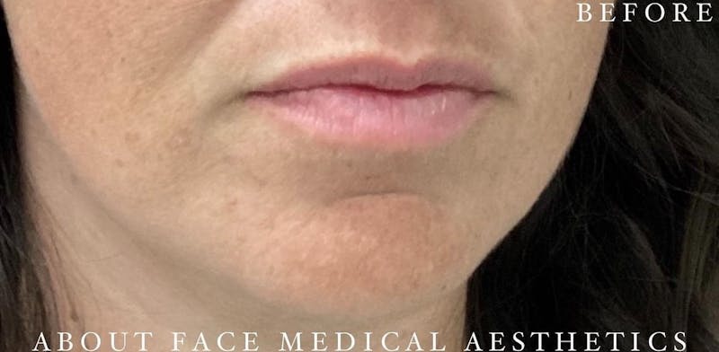 Dermal Filler Before & After Gallery - Patient 146210089 - Image 3
