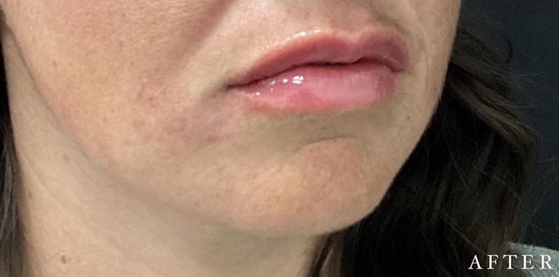 Dermal Filler Before & After Gallery - Patient 146210089 - Image 4
