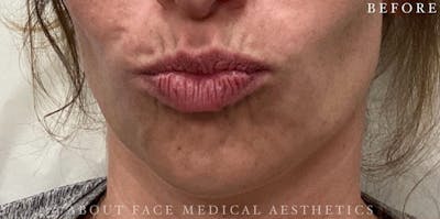 Dermal Filler Before & After Gallery - Patient 146210099 - Image 1