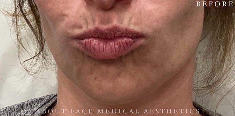 Dermal Filler Before & After Gallery - Patient 146210099 - Image 1