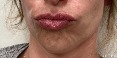 Dermal Filler Before & After Gallery - Patient 146210099 - Image 2