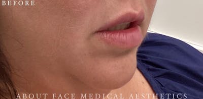 Dermal Filler Before & After Gallery - Patient 146210100 - Image 1