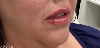 Dermal Filler Before & After Gallery - Patient 146210100 - Image 2