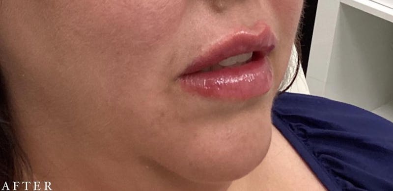 Dermal Filler Before & After Gallery - Patient 146210100 - Image 2