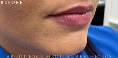 Dermal Filler Before & After Gallery - Patient 146210101 - Image 1