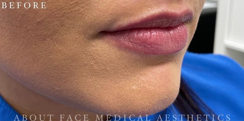 Dermal Filler Before & After Gallery - Patient 146210101 - Image 1