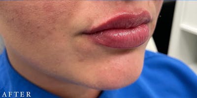 Dermal Filler Before & After Gallery - Patient 146210101 - Image 2