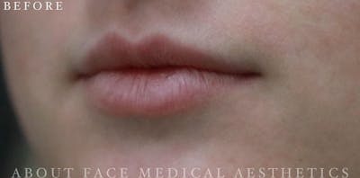 Dermal Filler Before & After Gallery - Patient 146210102 - Image 1