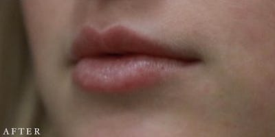 Dermal Filler Before & After Gallery - Patient 146210102 - Image 2