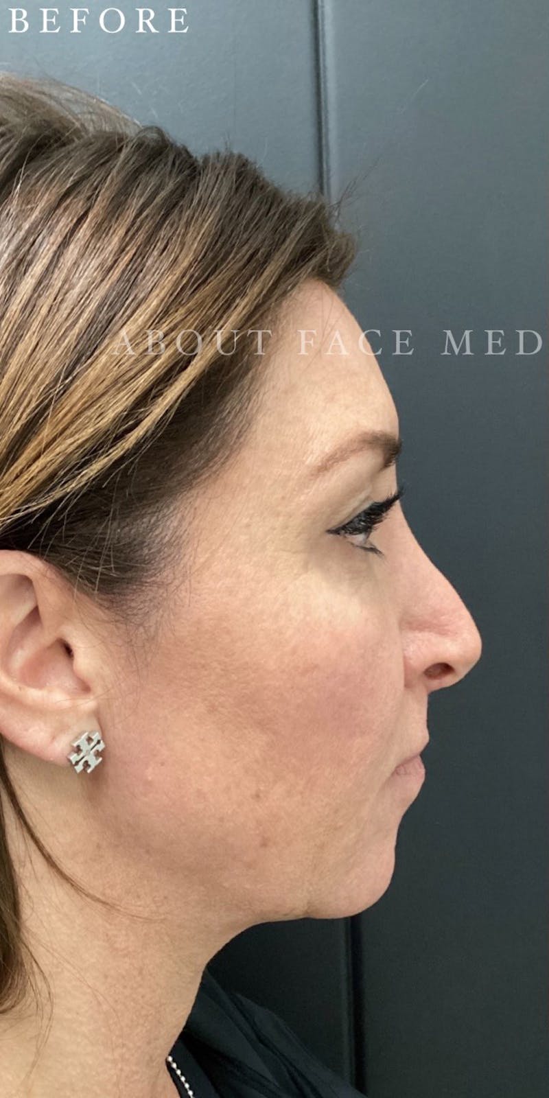 Dermal Filler Before & After Gallery - Patient 148257150 - Image 3