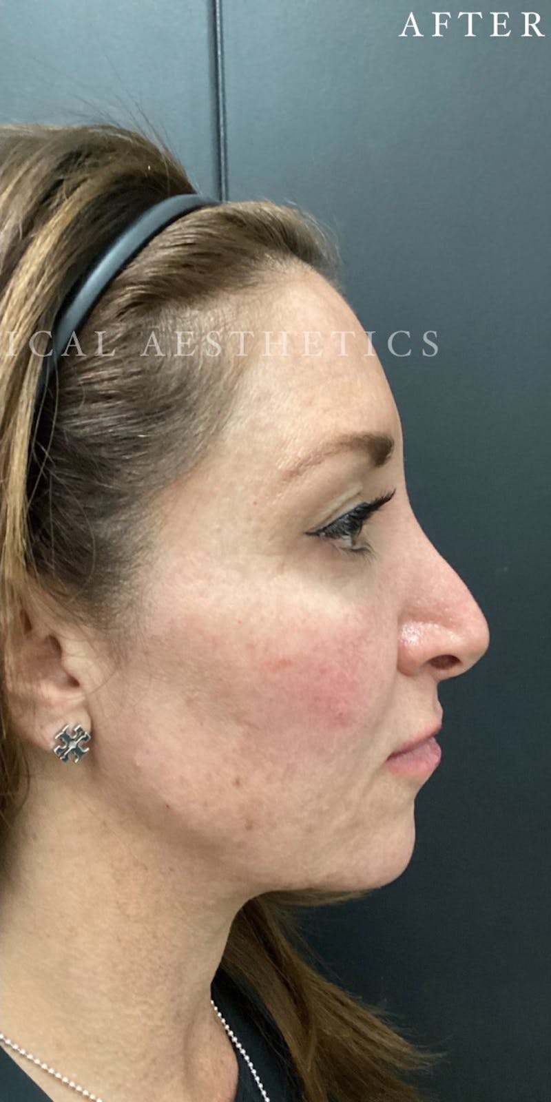 Dermal Filler Before & After Gallery - Patient 148257150 - Image 4