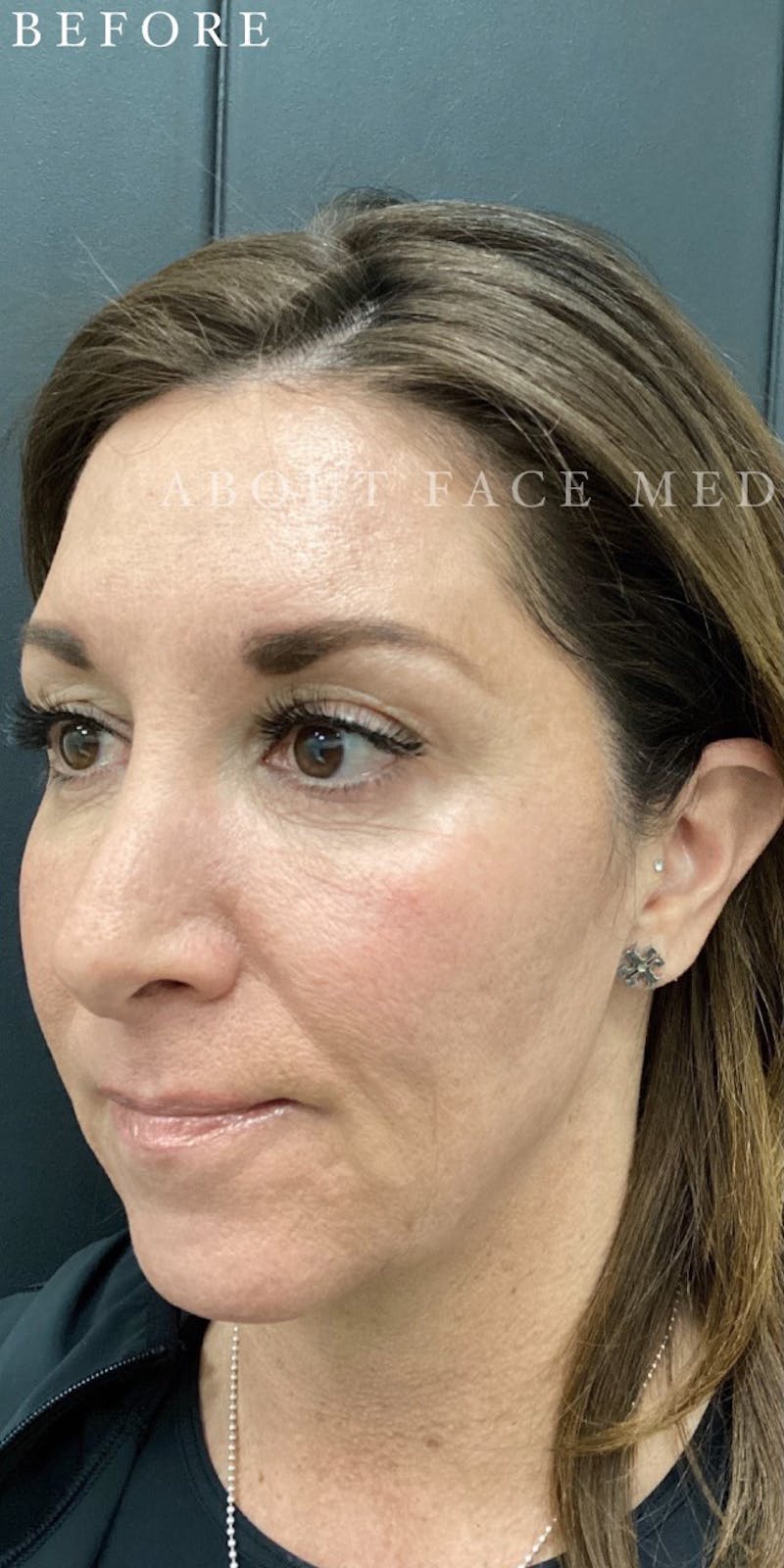 Dermal Filler Before & After Gallery - Patient 148257150 - Image 5
