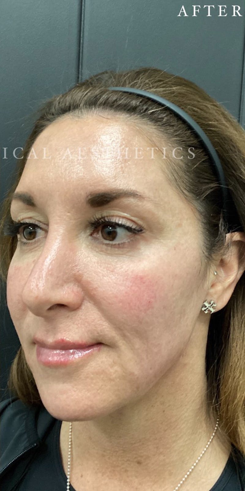 Dermal Filler Before & After Gallery - Patient 148257150 - Image 6