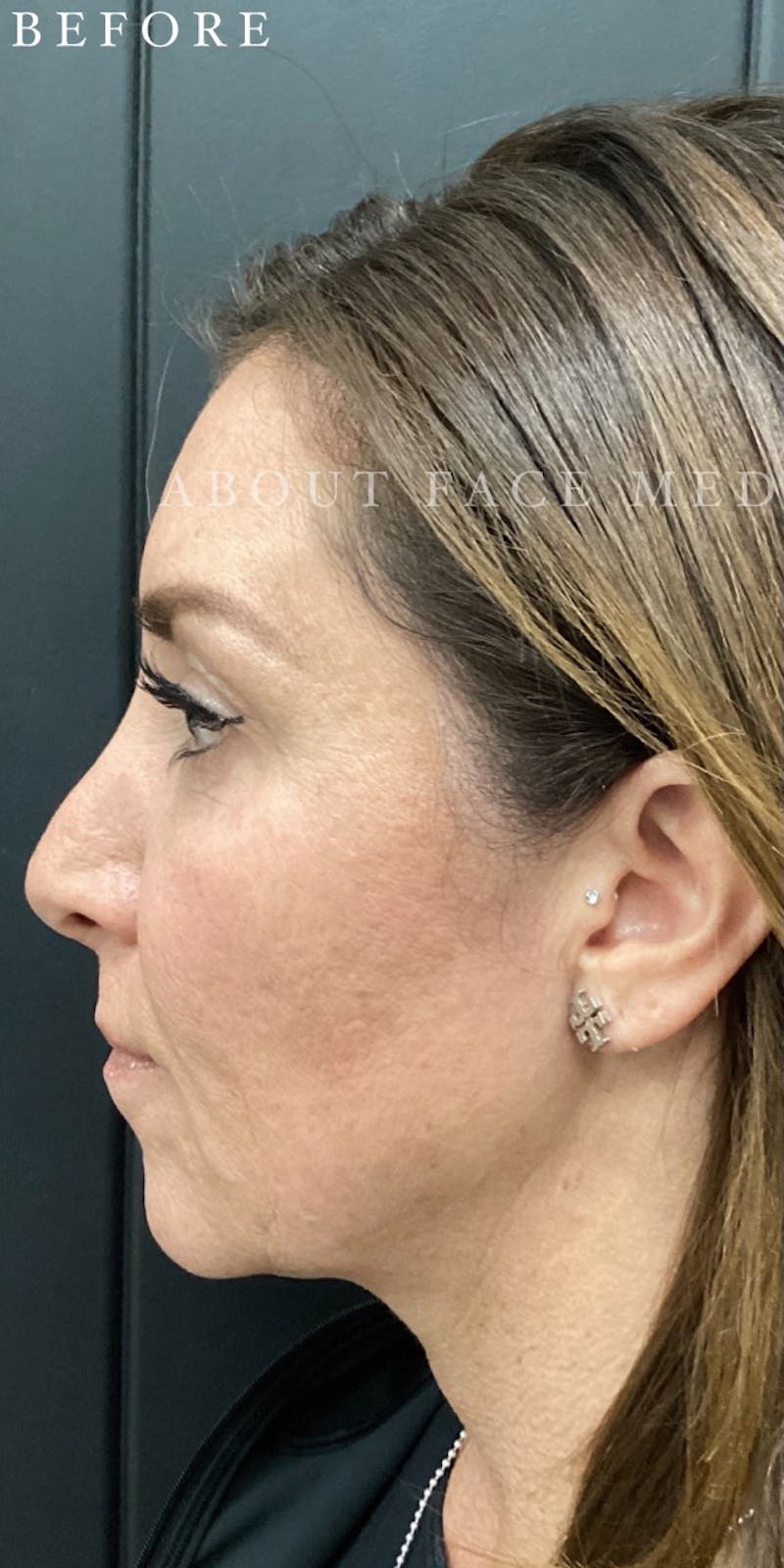 Dermal Filler Before & After Gallery - Patient 148257150 - Image 7