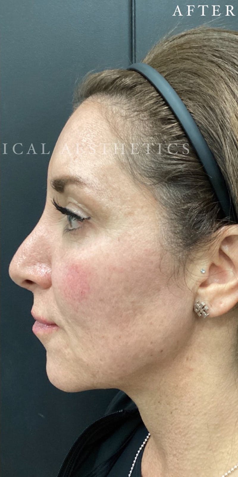 Dermal Filler Before & After Gallery - Patient 148257150 - Image 8
