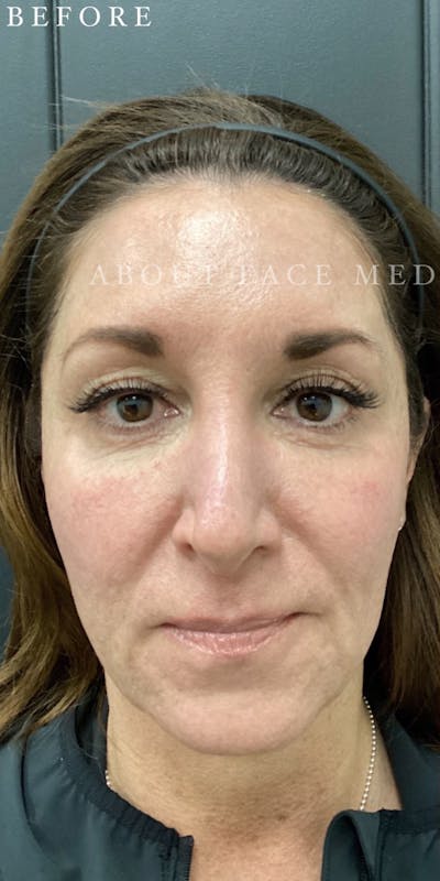 Dermal Filler Before & After Gallery - Patient 148257150 - Image 1