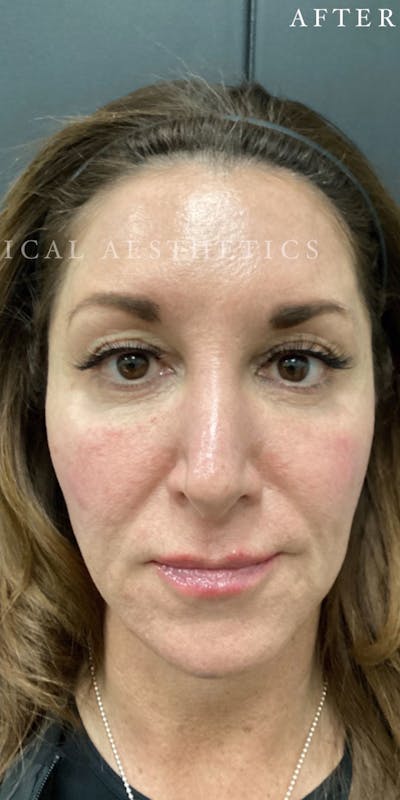 Dermal Filler Before & After Gallery - Patient 148257150 - Image 2