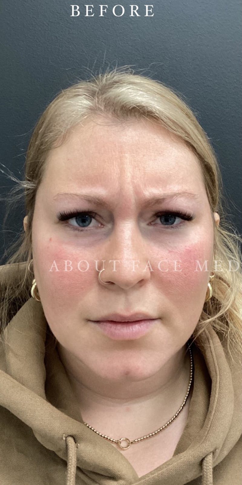 Botox Before & After Gallery - Patient 148257223 - Image 1