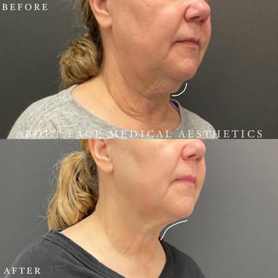 CoolSculpting Before & After Gallery - Patient 152123971 - Image 1