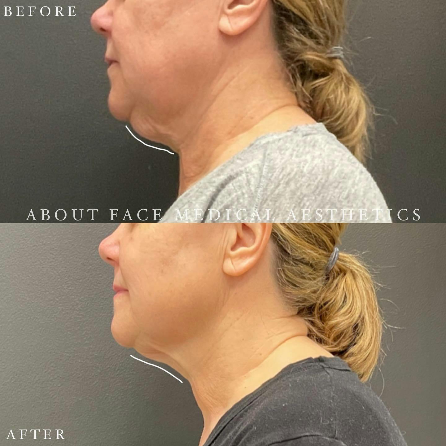 CoolSculpting Before & After Gallery - Patient 152123971 - Image 2
