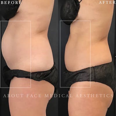 CoolSculpting Before & After Gallery - Patient 152123997 - Image 1