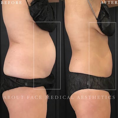 CoolSculpting Before & After Gallery - Patient 152123998 - Image 1